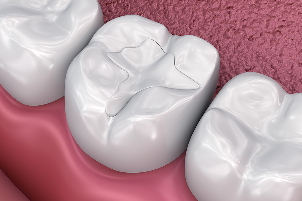 Dental Fillings Dental Fillings