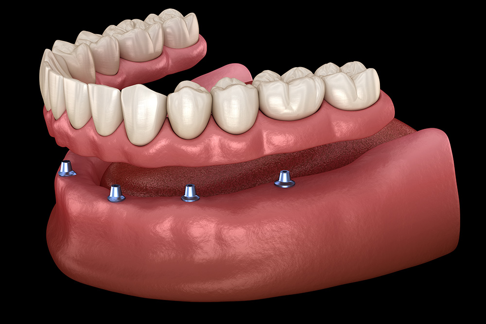 Implant-Support Dentures